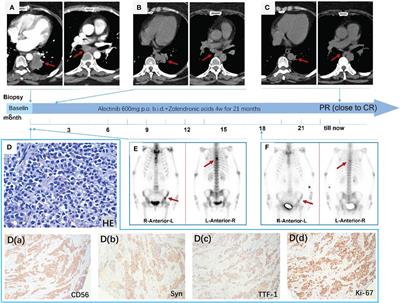 Two case reports: EML4-ALK rearrangement large cell neuroendocrine carcinoma and literature review